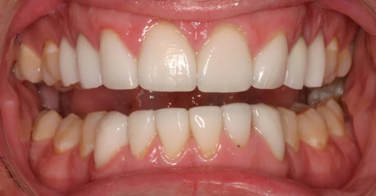 After Clear Aligners and Veneers, case 4