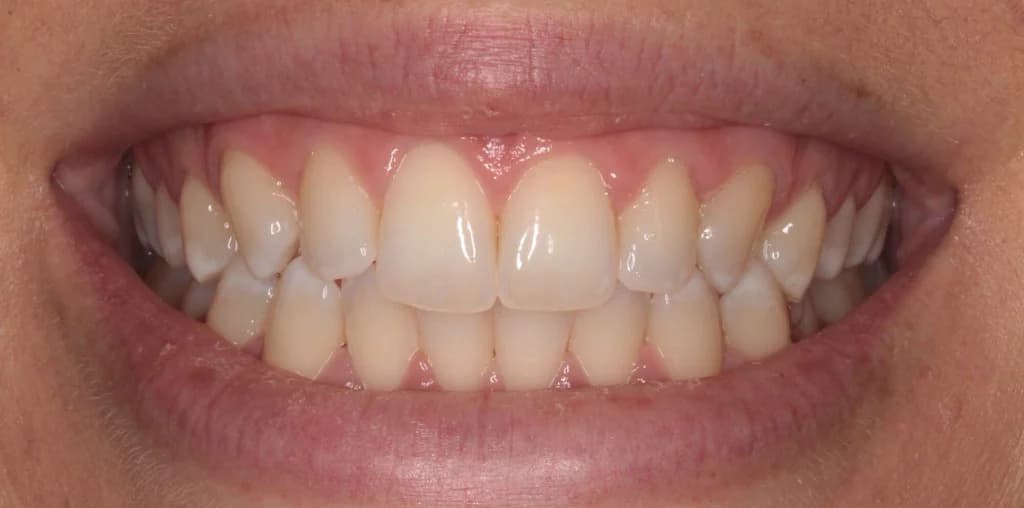 Before Whitening, case 3