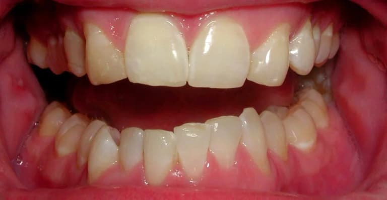 Before Clear Aligners and Veneers, case 4
